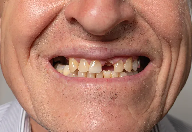 How Dental Bridges Prevent Jawbone Loss and Maintain Facial Structure?